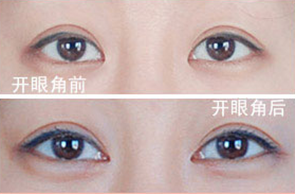要更大更有神的眼睛,开眼角手术前后对比图