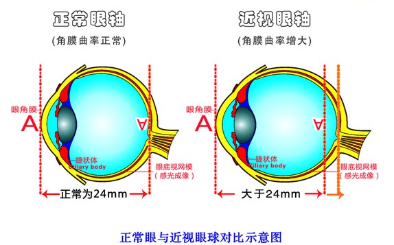 近视眼手术摘镜攻略不容错过